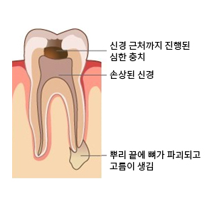 신경치료