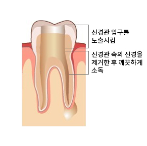 신경치료