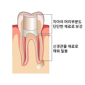 신경치료