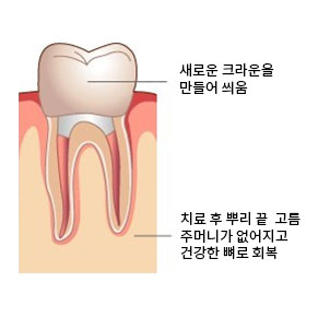 신경치료