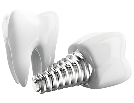의식하진정요법 임플란트